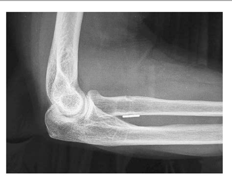 Figure 1 From Functional Outcome After Repair Of Distal Biceps Tendon