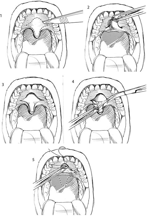 The Uvulopalatal Flap Operative Techniques In Otolaryngology Head And