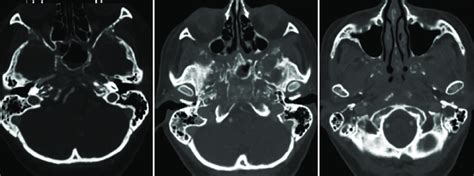 Axial Computed Tomography Scan Bone Window With Osteomyelitis