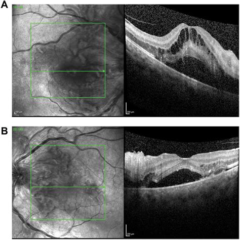 Optical Coherence Tomography Of The Macula Of The Right Eye A And