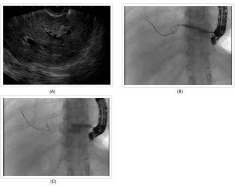 Endoscopic Ultrasound Guided Biliary Drainage Endoscopic Ultrasound