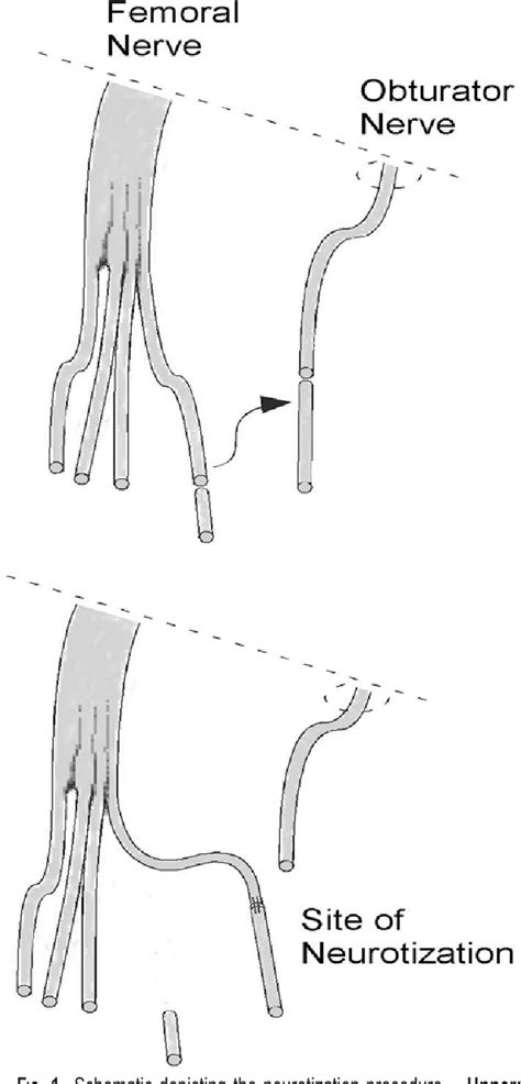 Figure From Femoral Branch To Obturator Nerve Transfer For