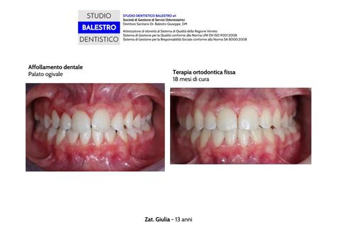 Casi Clinici Ortodontici Palato Ogivale