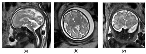 Normal Fetal Cisterna Magna Mri