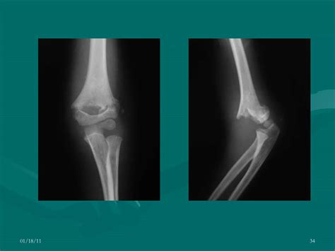 Fractura supracondílea intercondílea humeral PPT