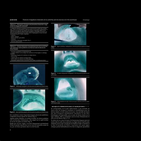 SOLUTION Tumeurs Et Dysplasies Tumorales De La Cavit Buccale Du