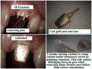 Dental Cements Luting Agents And Glue For Crowns