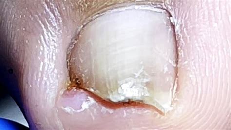 The Ingrown Toenail On One Side Breaks Deep Into The Toenail Pedicure