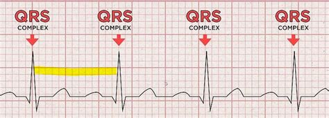 Heart Rhythm Analysis Regular Or Irregular Ecg Cerebro Medico