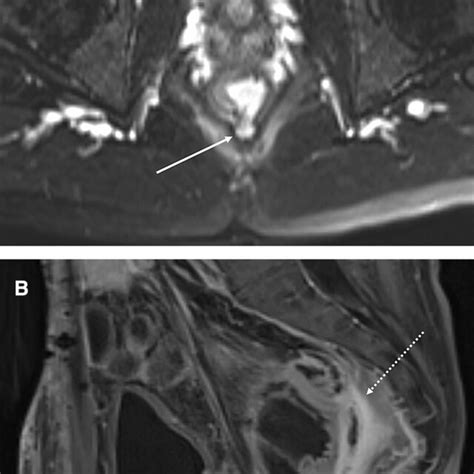 A Axial T2 Weighted Fat Saturated And B Sagittal T1 Weighted