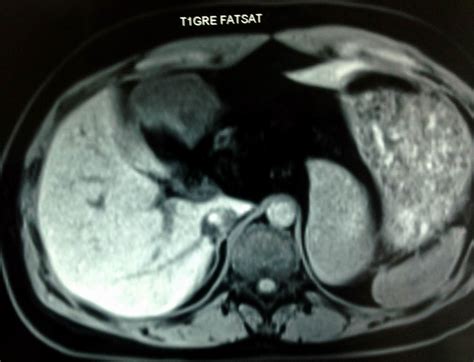 VIETNAMESE MEDIC ULTRASOUND: CASE 358: LESSER OMENTUM TUMOR, Dr PHAN ...