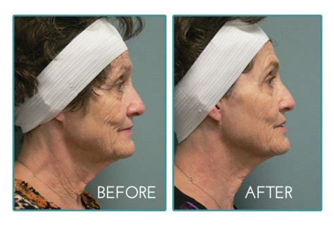 Ulthera Liftinglives Beforeandafter Laser Aesthetics