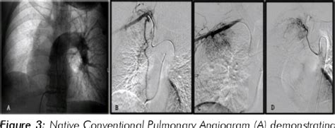 Figure From Proximal Interruption Of Right Pulmonary Artery In An