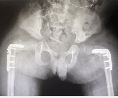 Four Weeks Postoperative AP Radiograph Of The Pelvis Demonstrating