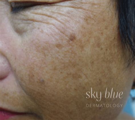 A Dermatologists Short Guide To Facial Pigmentation Sky Blue