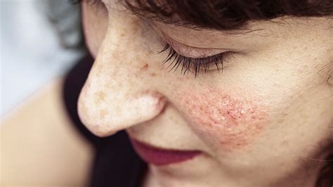 Rosacea Types Triggers And Treatment Options Gladskin