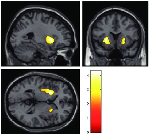 Results Of The Voxel Based Morphometry Vbm Analysis Results Reported