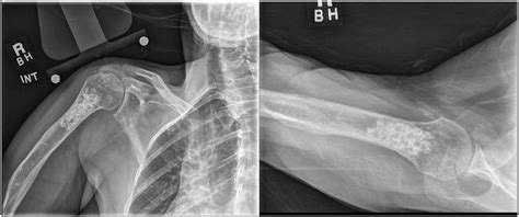 Anteroposterior and lateral radiographs demonstrating a superior-riding... | Download Scientific ...