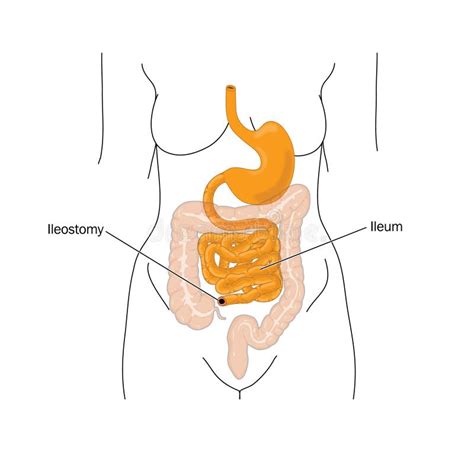 Dépose Des Grands Entrailles Et Ileostomy Illustration De Vecteur