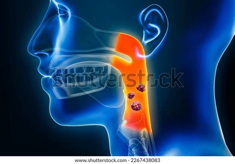 Pharyngeal Throat Cancer Organs Tumors Cancerous Stock Illustration 2267438083 Shutterstock