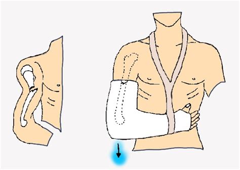 Hanging Cast For Humerus Fracture Therapy – FRACTURE