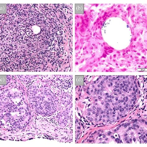 Core Biopsy Of The Breast A Granulomatous Lobular Mastitis