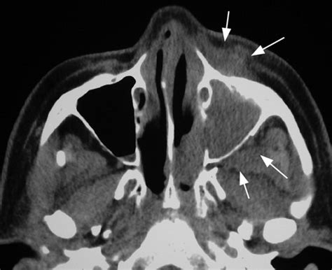 Imaging Features Of Invasive And Noninvasive Fungal Sinusitis A Review