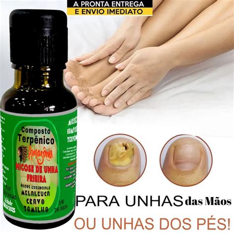 Melhor Remedio Para Unhas Com Fungos - Tratamento remédio de unhas com fungos melaeuca - cravo- e tomilho ...