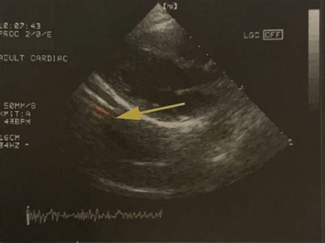 Ultrasound Physics Ii Ch Artifact Pictures Flashcards Quizlet