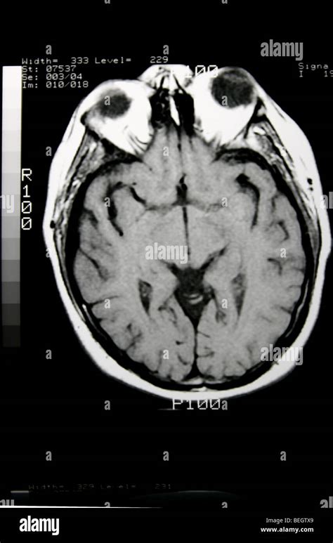 MRI scan of patient's brain with and without contrast agent Stock Photo - Alamy