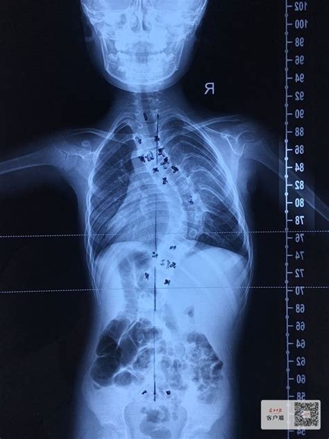 脊椎内长瘤令男童脊柱侧弯，专家手术扶正首页社会新闻中心长江网cjncn