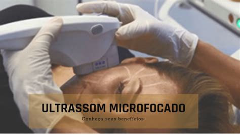 Os Benefícios Do Ultrassom Microfocado Injectors Club