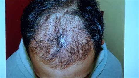 Fue Hair Transplant Follicular Unit Extraction Method Result Before After Dr Diep Mhtclinic