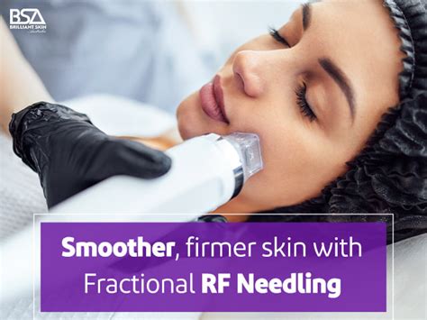 Fractional RF Needling Unlocking Radiant Skin