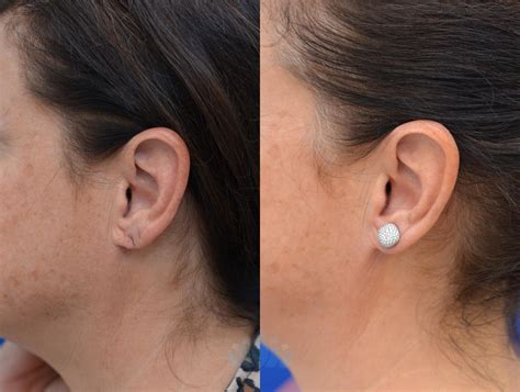 Earlobe Repair Before And After Pictures Case 88 Charlotte NC