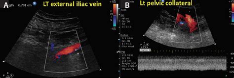 Diagnosis of Iliac Vein Obstruction With Duplex Ultrasound ...