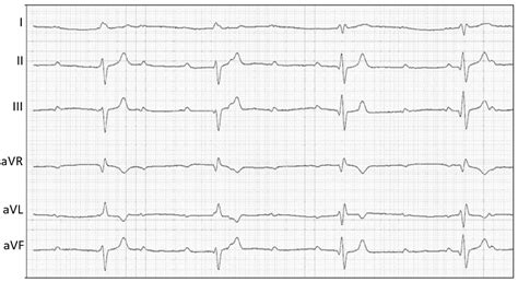 Endocarditis Ecg