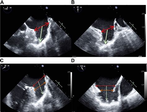 Percutaneous Left Atrial Appendage Closure