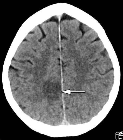 Ct For Treatment Selection In Acute Ischemic Stroke A Code Stroke