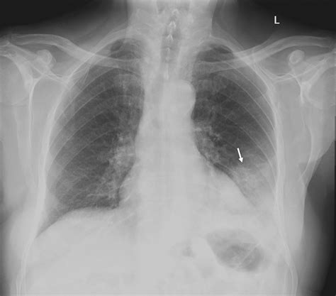 Chest X Ray Showing Left Lower Lobe Pneumonia Download Scientific Diagram