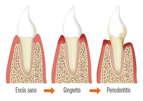 Periodoncia ¿qué Es Y Cómo Se Trata Amora Clínica Dental