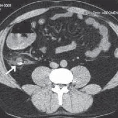 A B Distal Appendicitis Contrast Enhanced Axial CT Scan A Shows