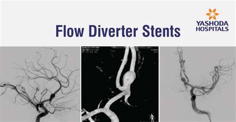 Flow Diverter Stents Types Treatment Risks And Complications