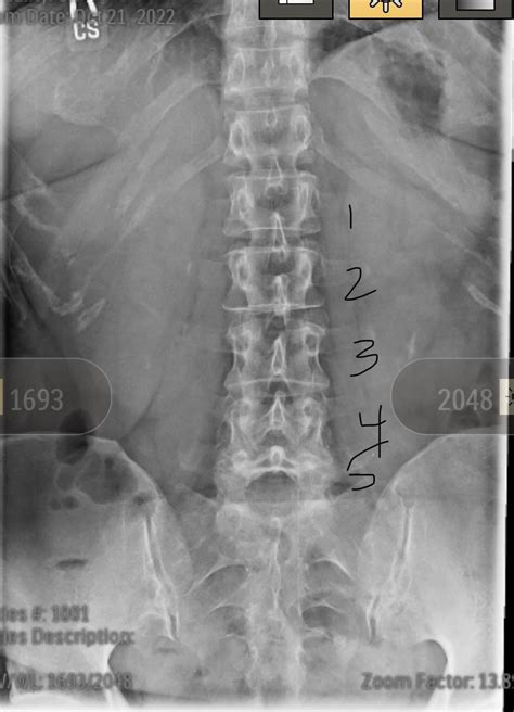 Lumbar fusion recommended : r/SpineSurgery