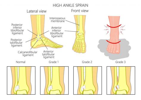 High Ankle Sprain Explained By An Ankle Specialist