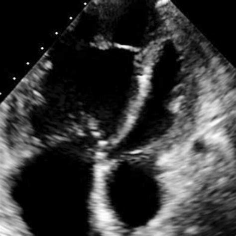 Transthoracic Echocardiogram Apical Fourchamber View Demonstrating