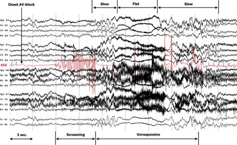 21 Lead EEG According To International 10 20 System Bipolar Montage