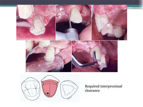 Tooth preparation for partial veneer crwns | PPTX