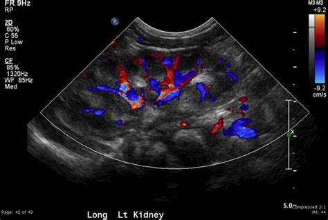 Renal Pyramids Ultrasound