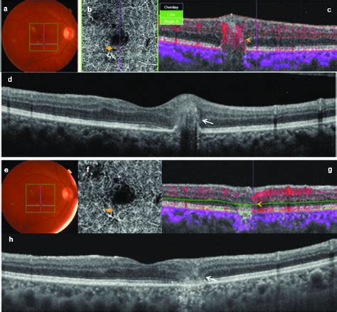 Baseline And Follow Up Swept Source Optical Coherence Tomography